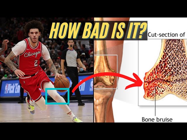 A MASSIVE SETBACKA: Chicago Bulls Elite Point Guard Lonzo Ball Will Not Be Part Of The Bulls Squad March 8th Vs...